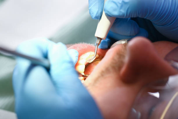 Best Emergency Dentist for Lost Fillings or Crowns in Fearrington Village, NC